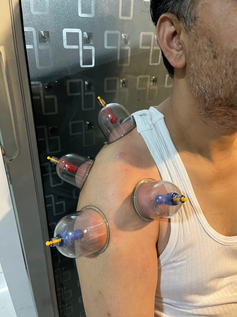 Cupping therapy treatment for shoulder pain at Krishna Sports Physio Clinic